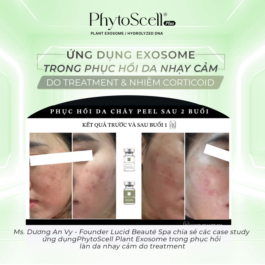 Ms. Dương An Vy chia sẻ về case lâm sàng ứng dụng PhytoScell trong phục hồi da nhạy cảm do treatment