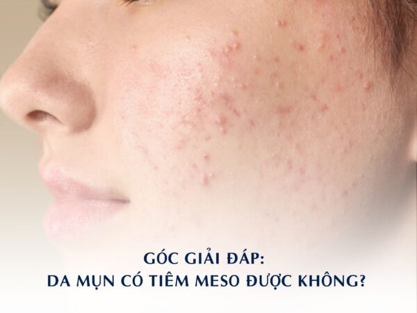 Góc giải đáp: Da mụn có tiêm meso được không?