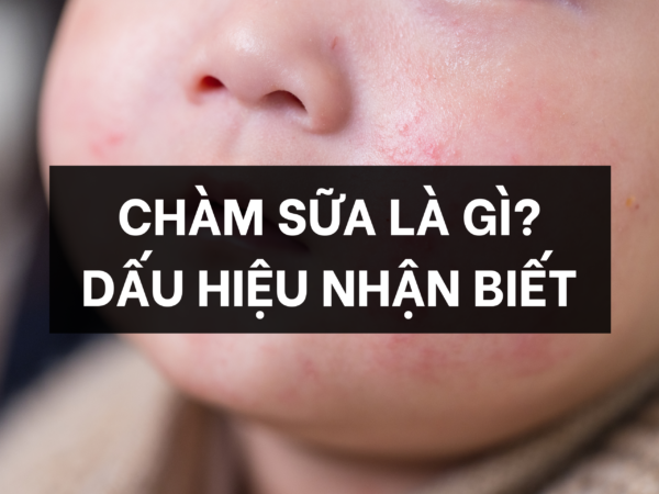 Chàm sữa là gì?