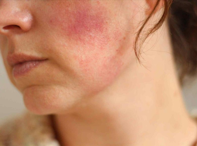 Việc lạm dụng corticoid khiết da rơi vào trạng thái mỏng yếu, nhạy cảm