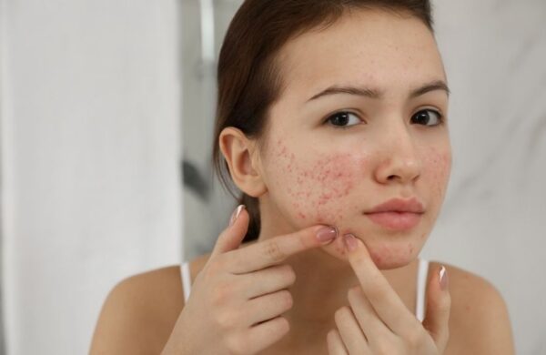 CHĂM SÓC DA DẦU MỤN HIỆU QUẢ CÙNG WHATASKIN