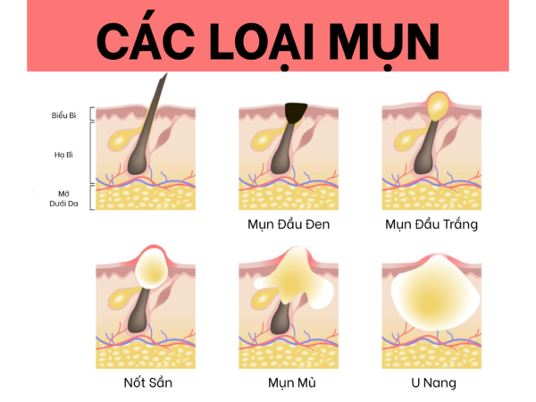 Mụn hình thành do đâu