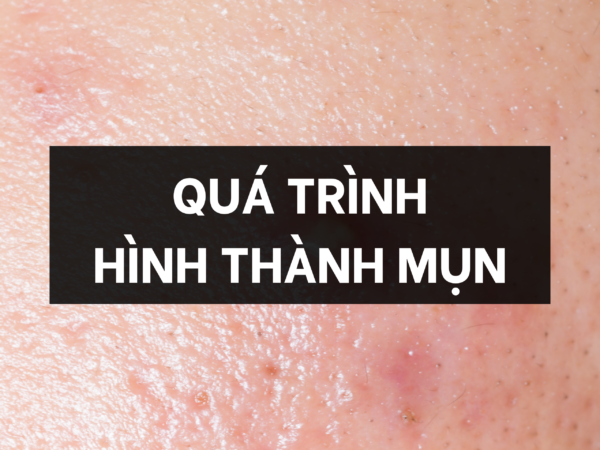QUÁ TRÌNH HÌNH THÀNH MỤN