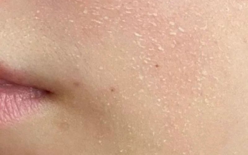 Cần chú ý các biểu hiện của da khô để khắc phục kịp thời