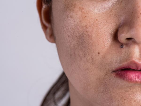 Da hỗn hợp là gì?