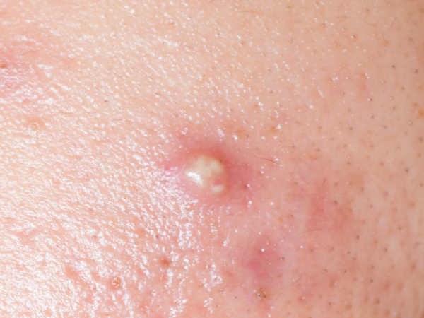 Lưu ý khi sử dụng Azelaic Acid