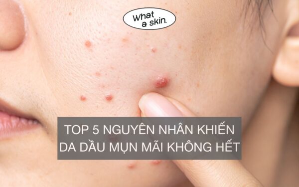 TOP 5 NGUYÊN NHÂN KHIẾN DA DẦU MỤN MÃI KHÔNG HẾT