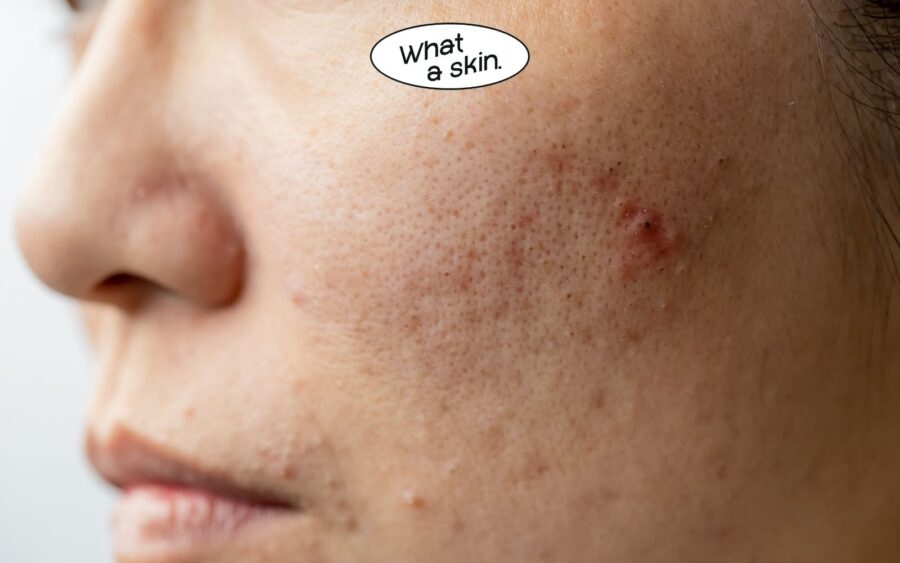 Bỏ quên bước phục hồi sau mụn: Để lại vết thâm và sẹo