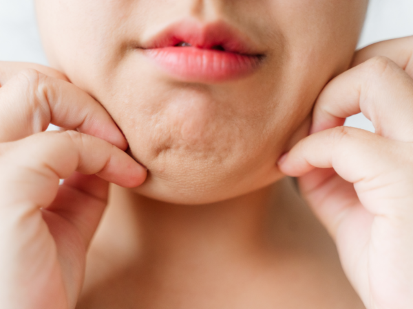 Cải thiên tình trạng mụn dưới cằm