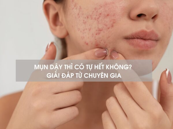 MỤN DẬY THÌ CÓ TỰ HẾT KHÔNG? GIẢI ĐÁP TỪ CHUYÊN GIA