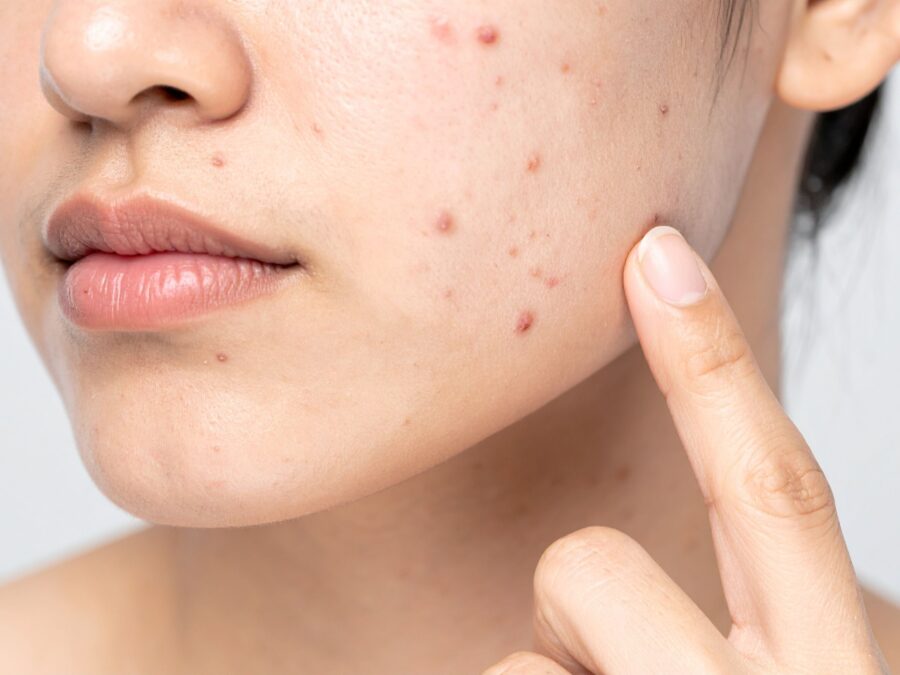 rửa mặt bằng nước muối sinh lý có tốt không
